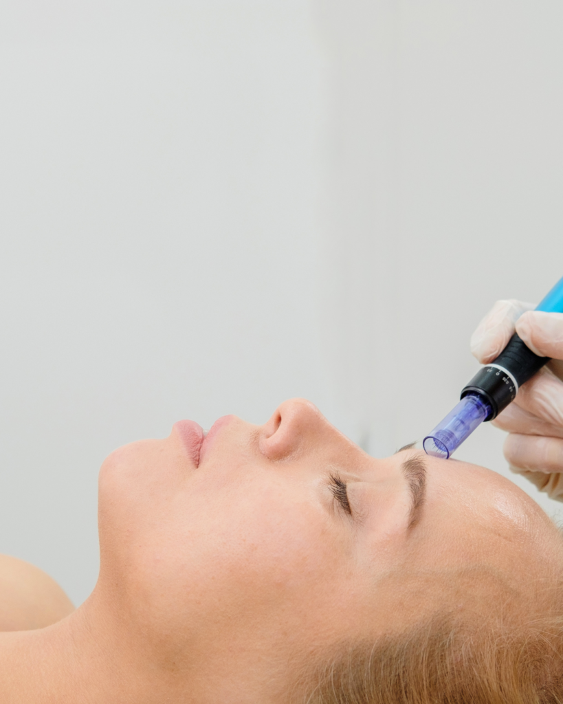 Microneedling